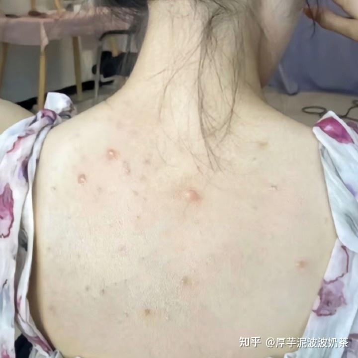 如何有效去除痘痘——打造无瑕肌肤的秘诀，如何有效去除痘痘，无瑕肌肤的打造秘诀