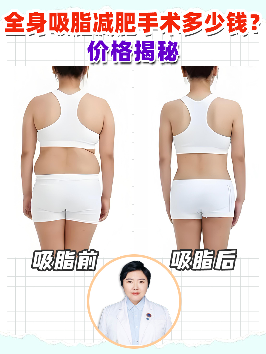 全身抽脂肪30斤的价格及其相关因素探讨，全身抽脂30斤价格及相关因素深度解析